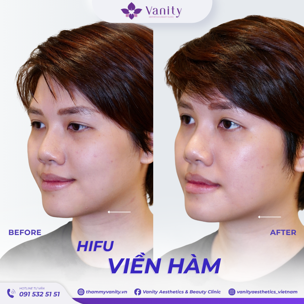 HIFU VIỀN HÀM